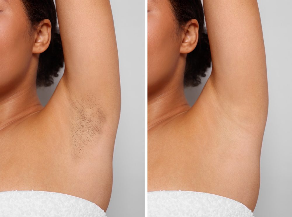Resultado antes e depois de depilação a laser
